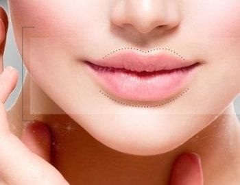 queiloplastia