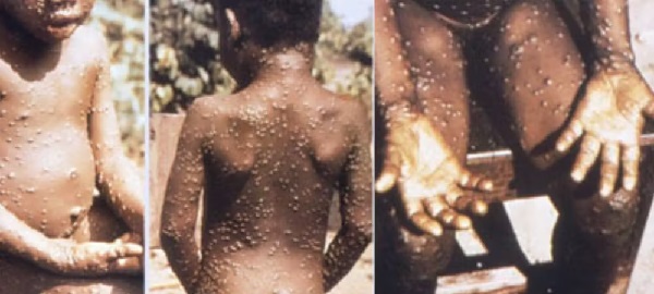 viruela del mono comienza en �frica